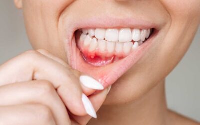 Bleeding Gums Are Not Normal