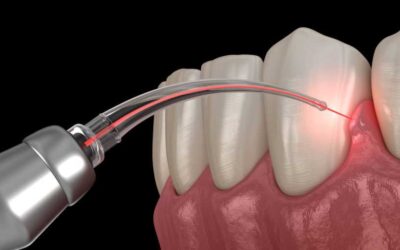 Gum Disease Doesn’t Have to Mean Surgery: What to Know About LANAP® Laser Therapy