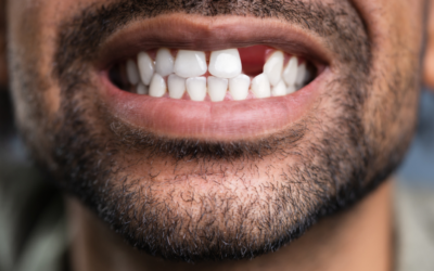 What Happens If You Ignore Missing Teeth (It’s More Than Just Cosmetic.)