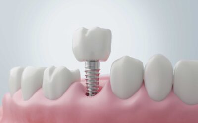 How Missing Teeth Can Change the Shape of Your Face